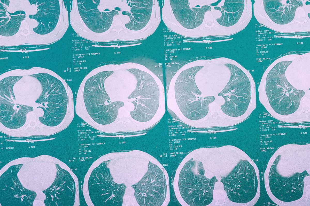 This Aggressive Lung Cancer Often Hides Until It’s Too Late