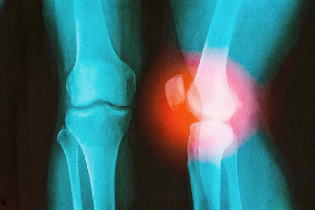 How a Surgeon With a Damaged Knee Learned to Outsmart Arthritis