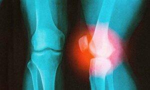 How a Surgeon With a Damaged Knee Learned to Outsmart Arthritis