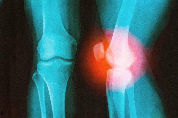 How a Surgeon With a Damaged Knee Learned to Outsmart Arthritis