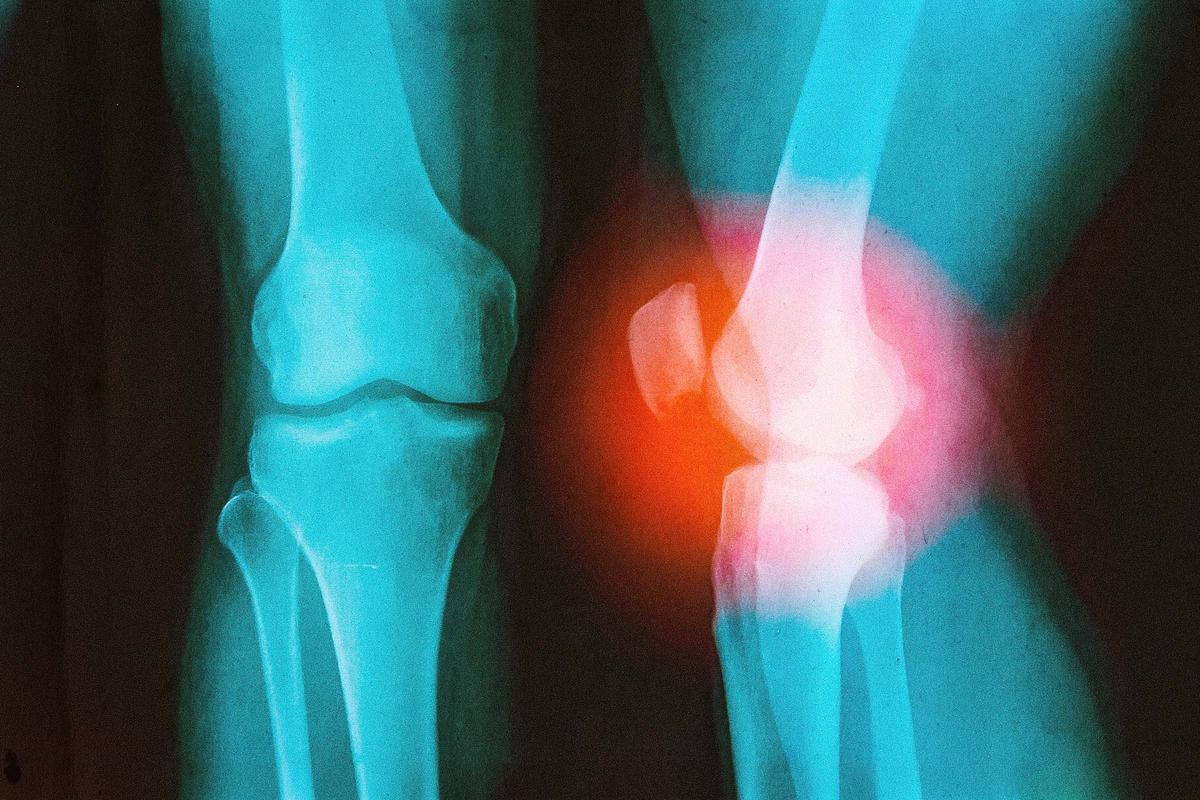 How a Surgeon With a Damaged Knee Learned to Outsmart Arthritis