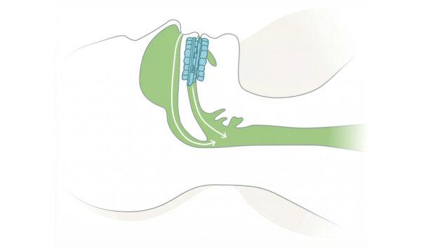 SnoreRX is a new doctor-recommended and FDA-cleared device is now helping millions of people stop snoring instantly.