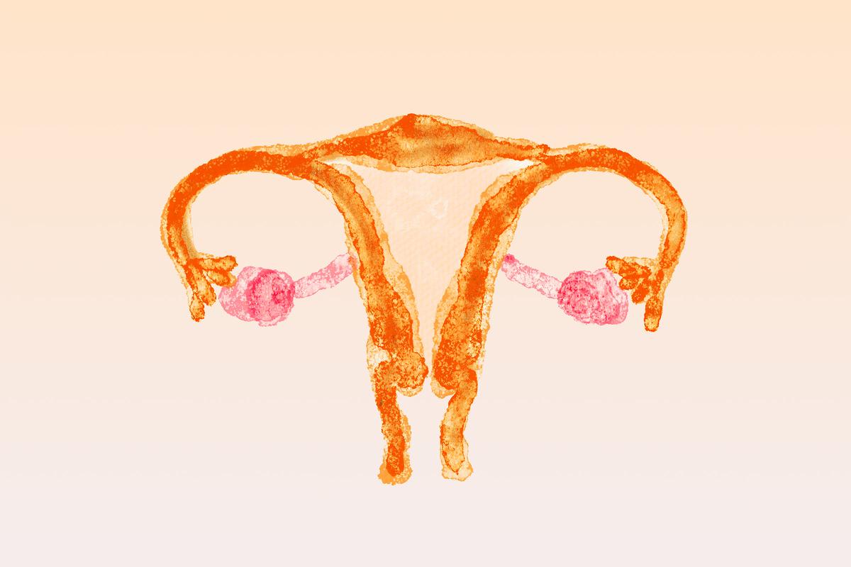 PCOS Was Never a Cystic Disease–It’s a Metabolic Syndrome