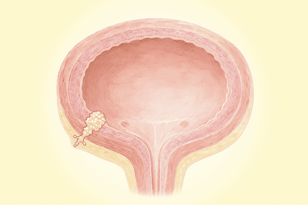 Bladder Cancer: Most Common Cancer of the Urinary System–Here Are the Warning Signs
