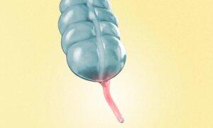 Removing the Appendix Linked to Higher Alzheimer’s Risks