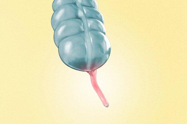 Removing the Appendix Linked to Higher Alzheimer’s Risks