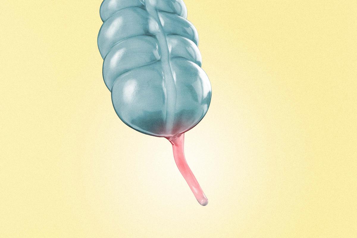 Removing the Appendix Linked to Higher Alzheimer’s Risks