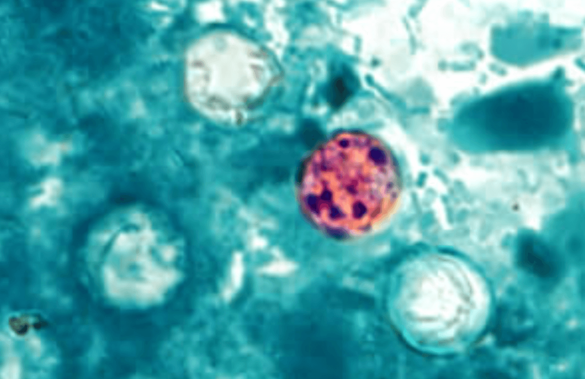 Outbreak of Diarrhea-Causing Parasite May Be Linked to Lettuce, Salad Greens: Officials