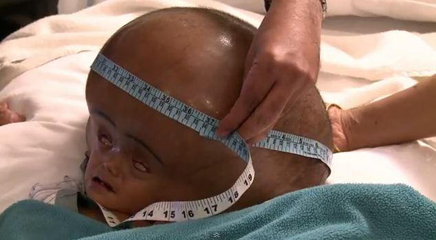 Roona Begum: Giant Headed-Baby Saved by Emergency Surgery 