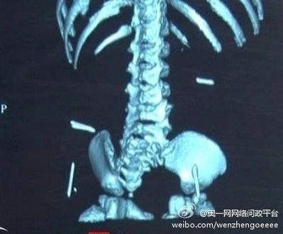 Doctor in China Removes Sewing Needles From Baby’s Body
