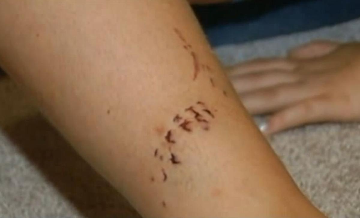 Shark Attack: Tooth Will be Kept as Souvenir by Riley Breihan, 11