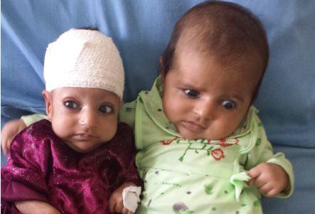 Afghan Baby Born With 2 Heads Survives Operation