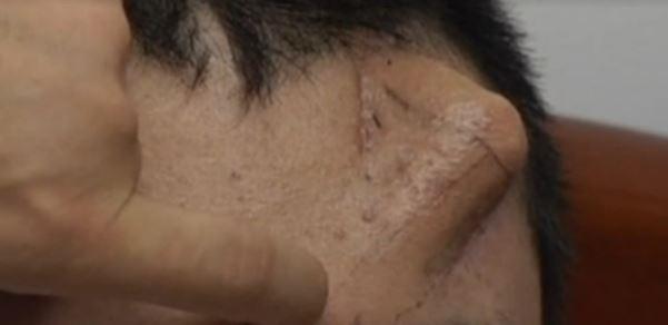 Xiaolian Nose: Nose Grows on Man’s Forehead (+Photos)