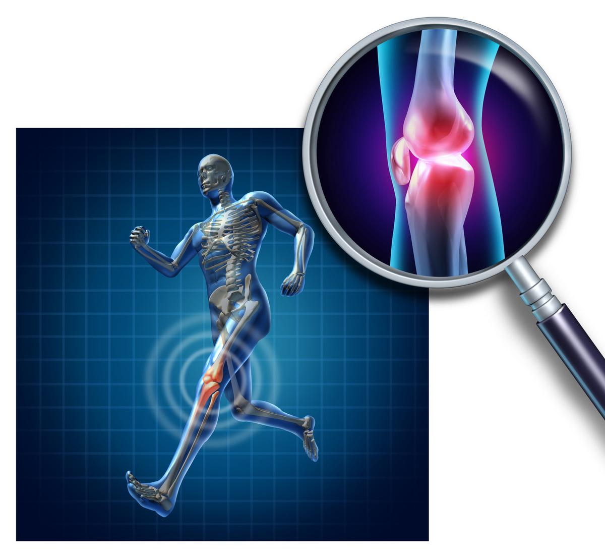 2 Types of Osteoarthritis and 4 Methods of Prevention