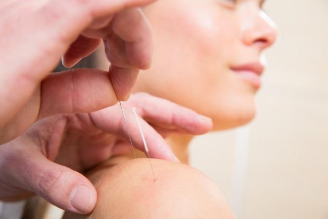 Acupuncture Placebo Sham Revealed