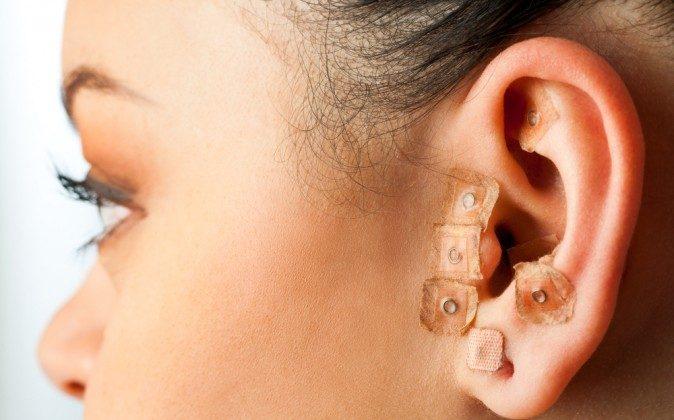 Auricular Acupuncture Weight Loss Found Effective