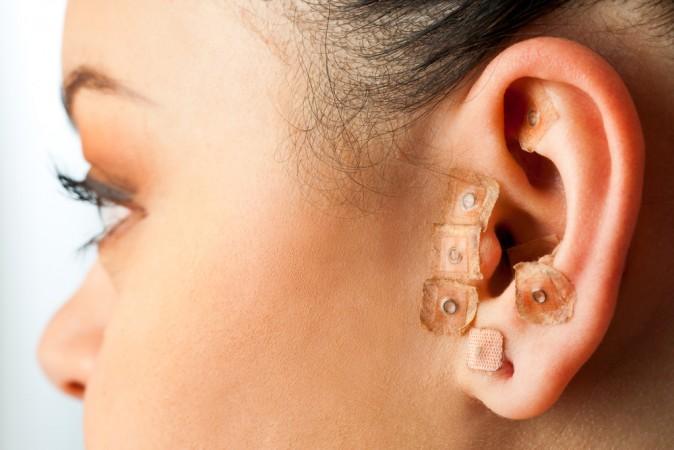Auricular Acupuncture Weight Loss Found Effective