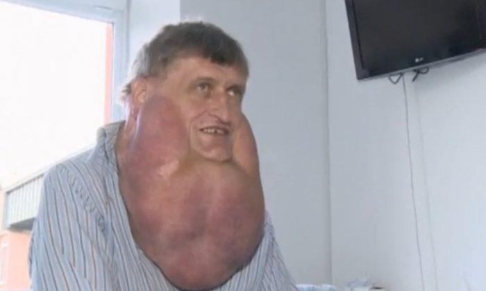 Giant 6 Kilogramme Tumour Removed From Man’s Face (Video)