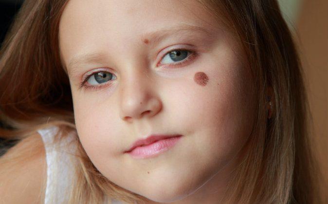 A Theory on How Birthmarks Could Correspond to Wounds From Past Lives