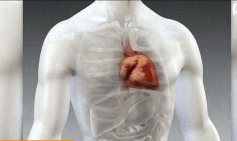 New Drug Could Reduce Cardiovascular Deaths (Video)