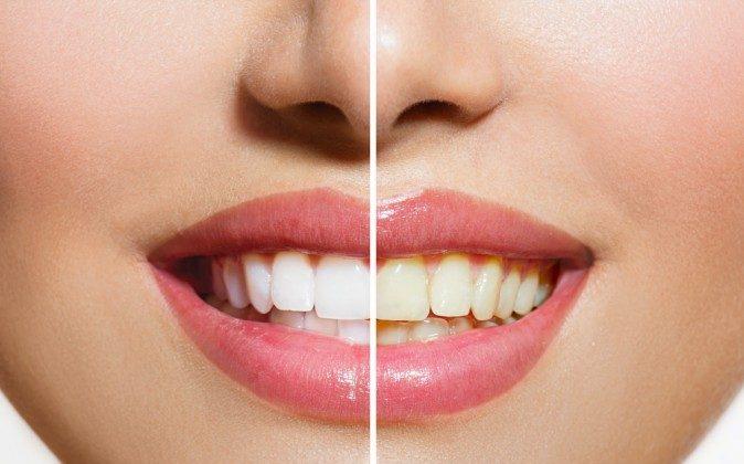 Top 5 Natural Tooth Whiteners