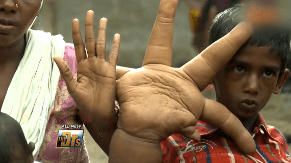 Indian Boy Is Born with 35-Pound Hands (Video)