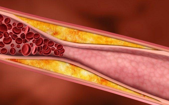 How To Clean Your Arteries With One Simple Fruit