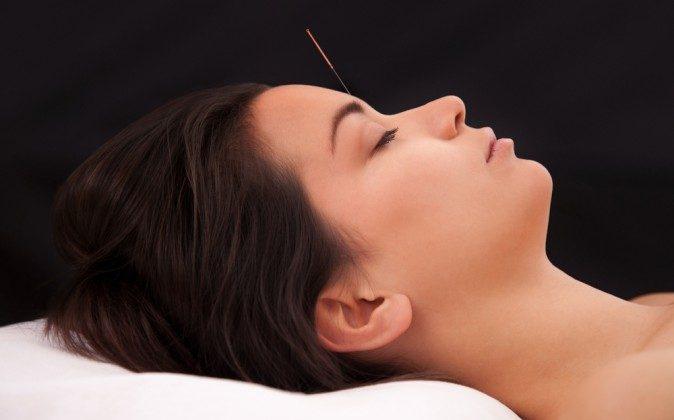 Acupuncture Relieves Migraines