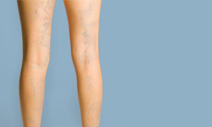 Varicose and Spider Veins: The Cure and Consequences of Misdiagnosis