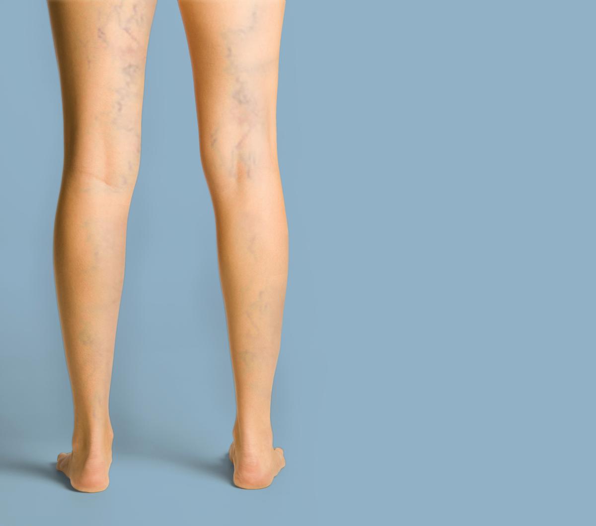 Varicose and Spider Veins: The Cure and Consequences of Misdiagnosis