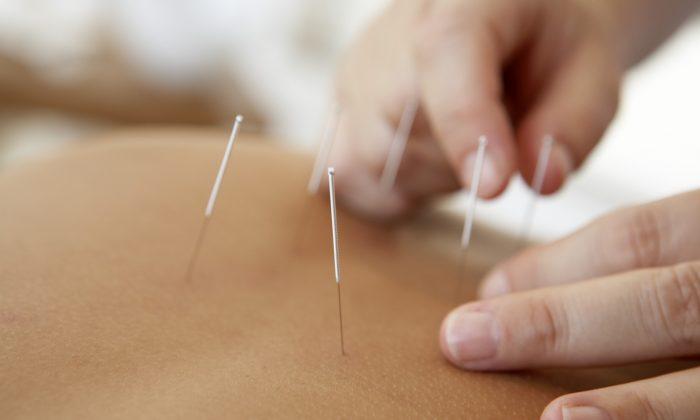Treating Parkinson’s With Acupuncture 