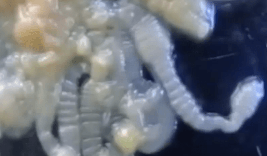 X-Ray Reveals Parasitic Worm Inside Man’s Foot (Video)