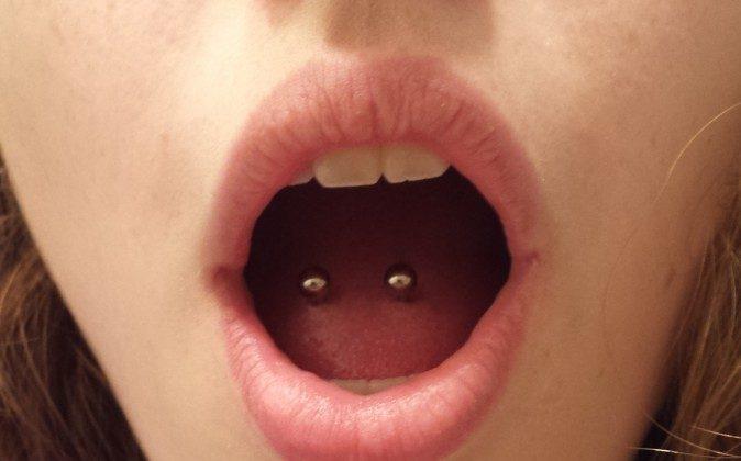 Tongue Piercings Cause GI Pain, Acupuncture Helps