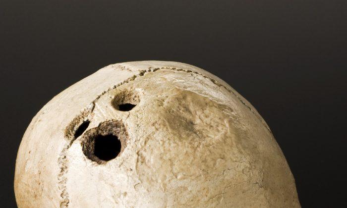 Advanced Ancient Knowledge: Brain Surgery 2,500 Years Ago