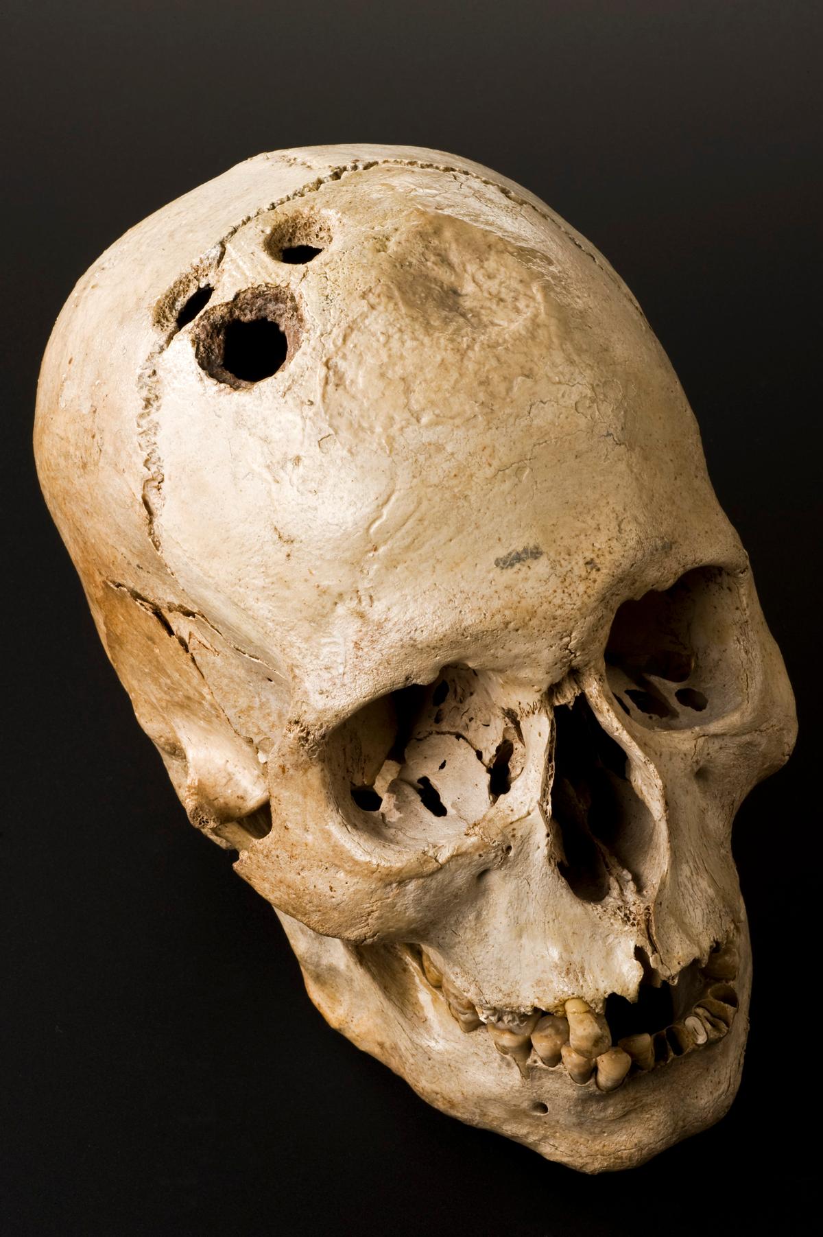 Advanced Ancient Knowledge: Brain Surgery 2,500 Years Ago