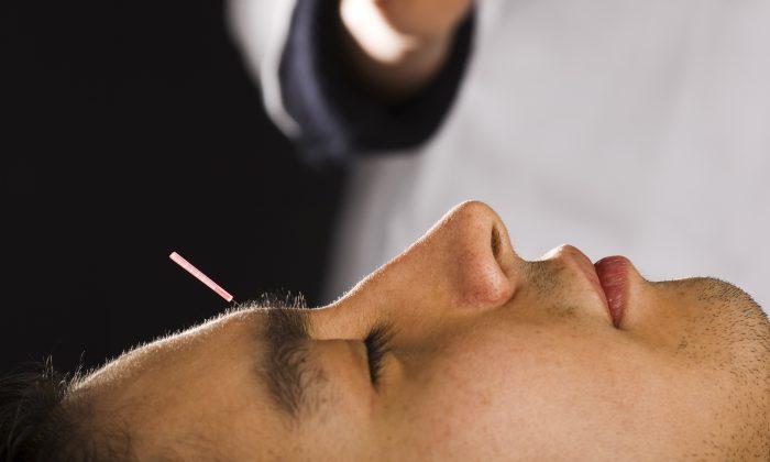 Can Skeptics Ease Their Pain With Acupuncture?