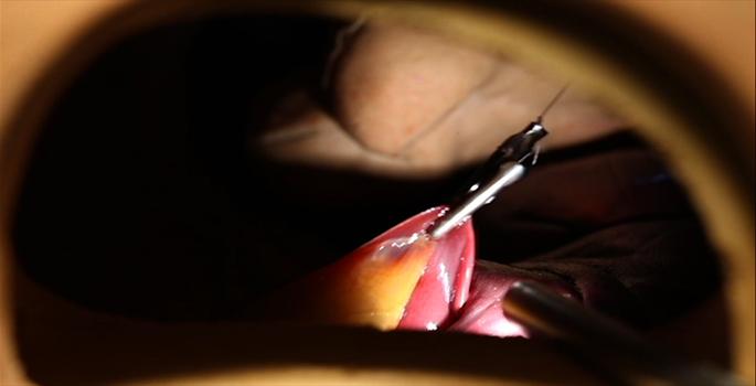 Magnets Let New Tool Move Organs for Surgery