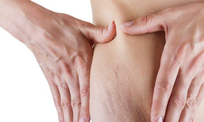 Why Do I Have Stretch Marks and What Can I Do About Them?