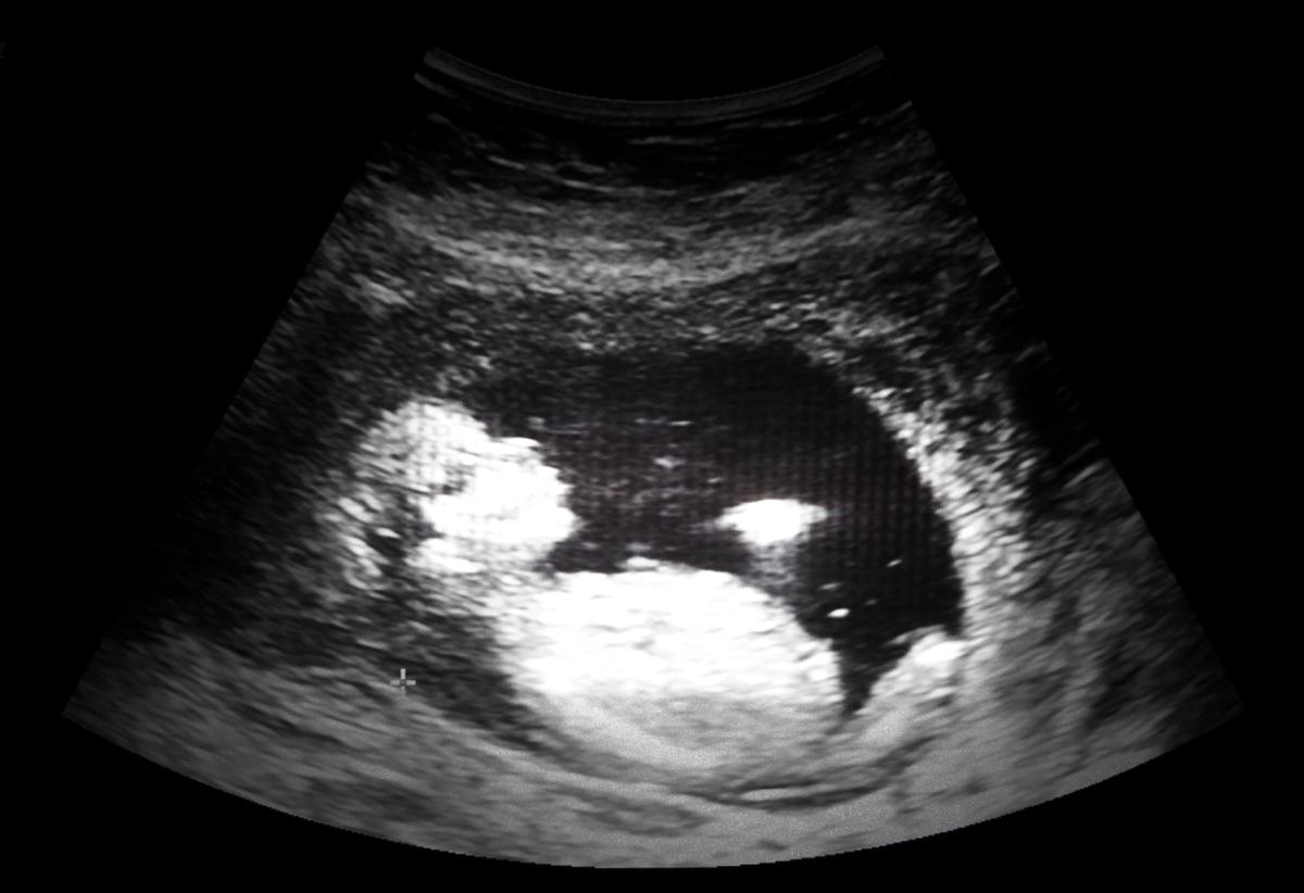 Ultrasound film of a thirteen-week fetus. (Kornn Photo/iStock)