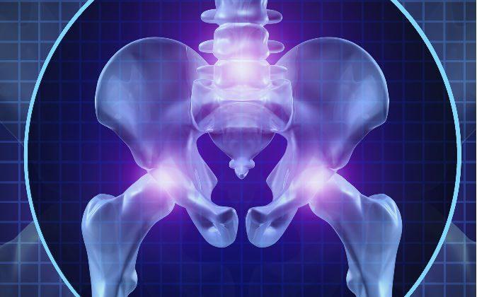 Fractures More Likely After Hip Replacements
