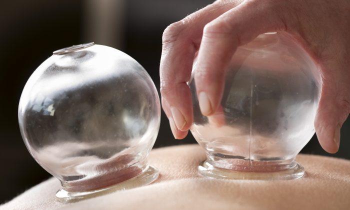 3 Reasons Why You Should Try Cupping