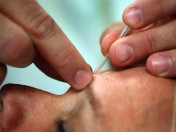 Acupuncture Affects How Brain Perceives Pain