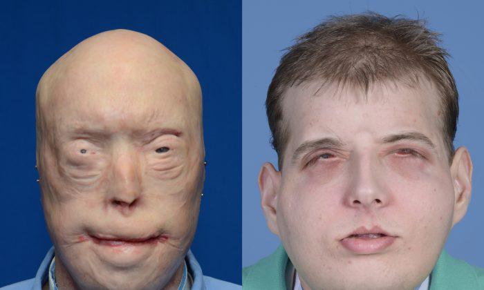 Transplant Gives New Face, Scalp to Burned Firefighter