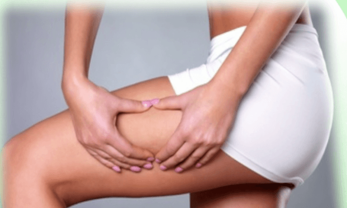 Beyond Creams: Tips to Prevent and Treat Cellulite