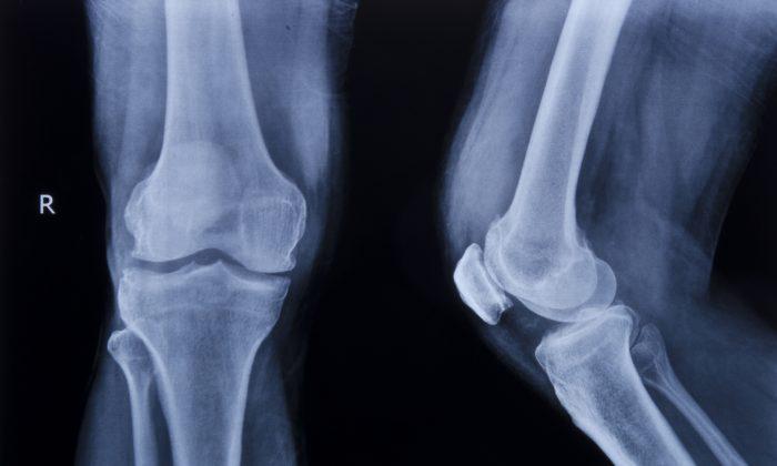Study: Knee Surgery No Better Than Placebo