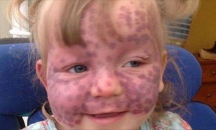Meet the Little Girl With Sturge-Weber Syndrome Who Is Covered in Polka Dots
