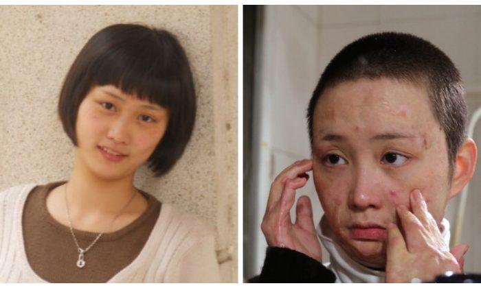 The Struggles of a Chinese Woman Disfigured by a Vengeful Admirer