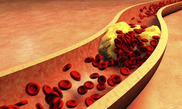 Plaques in Arteries Are Reversible