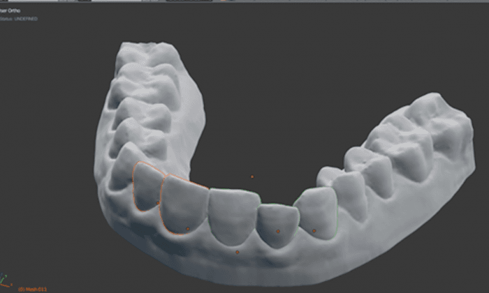 Student 3-D-Prints Own Braces, Saves Almost $8,000