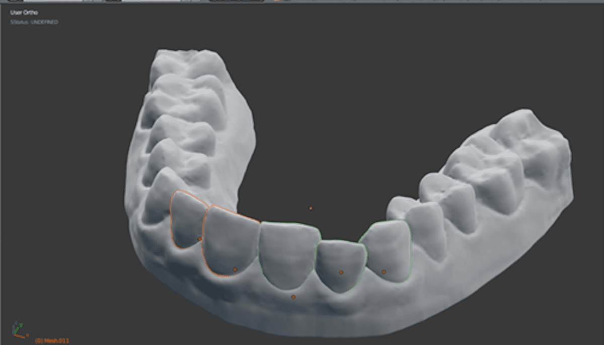 Student 3-D-Prints Own Braces, Saves Almost $8,000